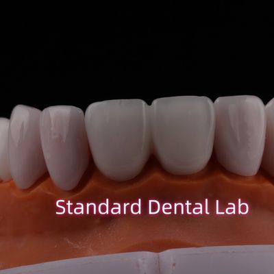 Beli Translucent Emax Zirconia Laminate Veneers Porselen Dental Veneers Secara Kimia Berkualitas pembuatan online