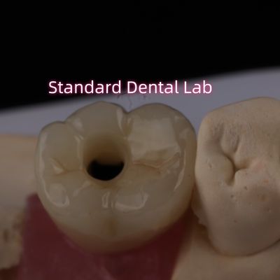 Beli Posterior Implant Crown Bruxier Solid Zirconia Screw Dipegang pembuatan online