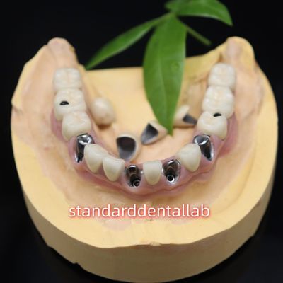 Beli Screw Dipegang Implantasi Gigi Keramik Metal Mahkota Malo Jembatan pembuatan online