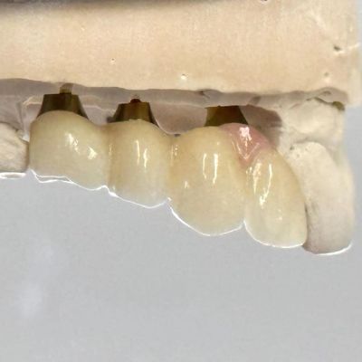 Beli Porselen Zirconia Cement Dipegang Screw Implant Bentuk Kepala Heksagonal untuk Custom Fit Estetika pembuatan online