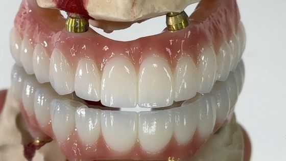 Beli Dental All On X Implant PFM Crown Titanium Fixed Hybrid Denture pembuatan online