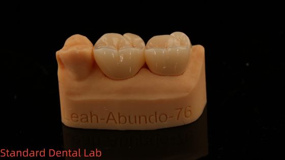 Beli Mahkota Lab Gigi Solid 3D Pro Translucence Tinggi Mahkota Zirconia penuh dengan garansi 5 tahun pembuatan online