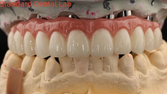 Beli Porselen Semua Pada Empat Zirconia Jembatan Estetika Tinggi Dental Implan Jembatan Sekrup Tetap pembuatan online