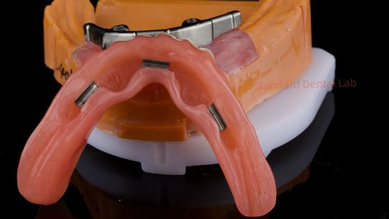 Beli Ivoclar Digital Dental Implant Bar Denture dengan Attachments Full Acrylic Denture Titanium Denture yang Didukung Implant pembuatan online