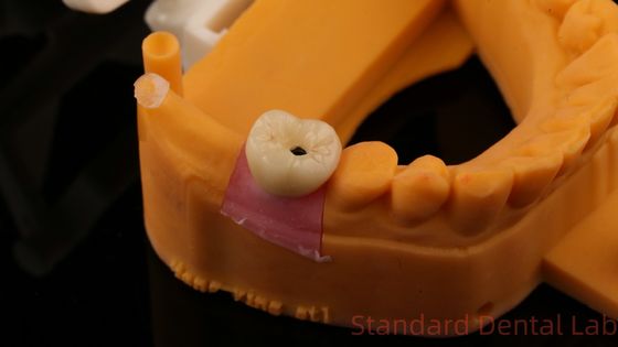 Beli Implan Gigi Sekrup Crown PFZ Porselen Berlapis Zirconia Dengan Model Cetak 3D pembuatan online