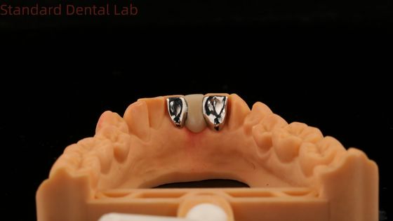 Beli Dental PFM Maryland Bridge Estetika Tinggi FDA Bersertifikat Dengan Vita Porcelain China Dental Lab pembuatan online