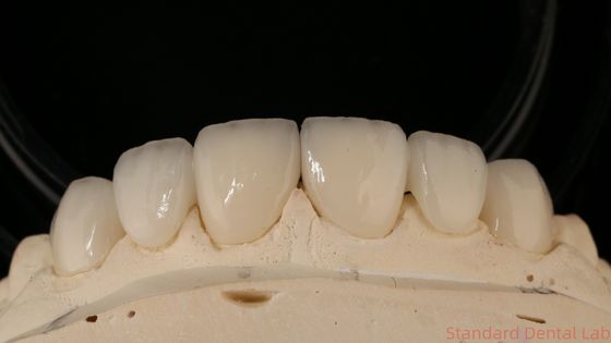 Beli Precision Zirconia Crown Bridge Comfortable Fit / Estetika 3-4 hari Waktu pengiriman cepat pembuatan online