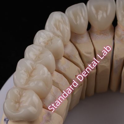 Digital CAD CAM Dental Lab PFZ Mahkota Translucent Layered Zirconia Mahkota