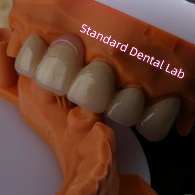 Sangat Biokompatibel PFZ Porselen Berlapis Zirconia Dengan Permen Karet Pink
