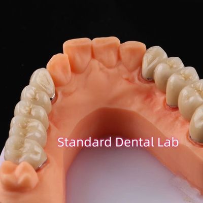 Digital Non-Elyse Metal Porcelain Crown PFM Jembatan Gigi