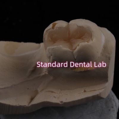 Cast Porcelain Dental Inlay Onlay Overlay Zirconia Emax Estetika Tinggi