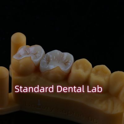 Komposit Resin Zirconia Emax Metal Inlay Onlay Overlay