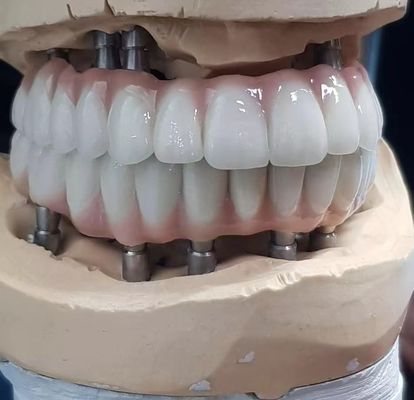 Zirconium Implant Screw Cement yang dibuat dengan presisi untuk gigi yang terlihat alami