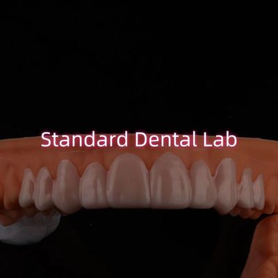 Dental Snap On Smile Veneers untuk perubahan warna gigi / celah