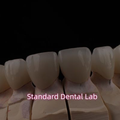 Jembatan Zirconia Keramik Berlapis Gigi PFZ Dengan Incis Translucent