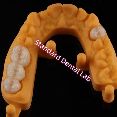 Mahkota Semua Porselen Keramik Zirconia Ivoclar Gigi Estetika OEM