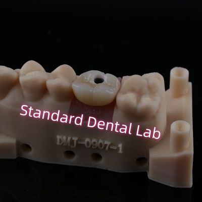 Custom Abutment Implant Crown Full Contour Zirconia Screw Dipegang