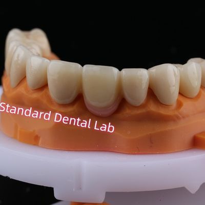 Digital CAD CAM Milling Layered Zirconia Bridge Crown Dengan Porselen Pink
