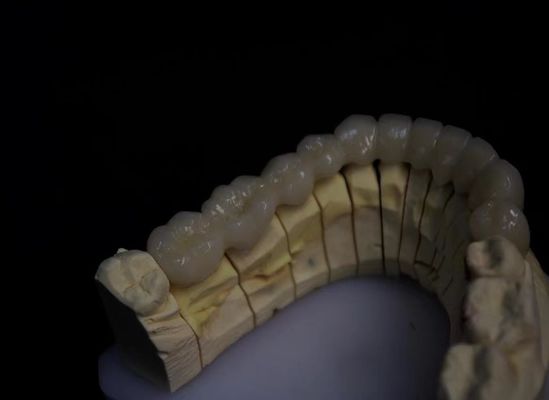 Porselen berlapis Zirconia