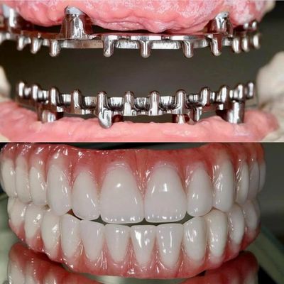 Dental Hybird Malo Implant Bridge Profesional Perfect Fit FDA Certified