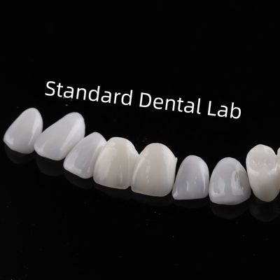 Gigi Estetika Tinggi Emax Laminate Veneers Translucence Incisal