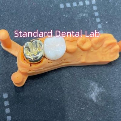 Mahkota Alloy Logam Kuning Tidak Berharga Full Cast Dengan Mahkota Zirconia