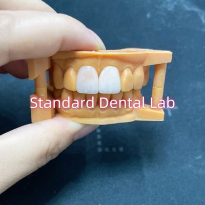 Stabilitas Warna Tinggi Ivoclar Emax Laminate Veneers Translucence Tinggi