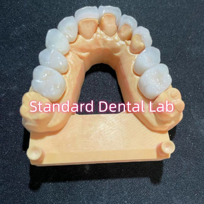 High Esthetic Hollywood Smile Penggilingan Emax Laminate Veneers