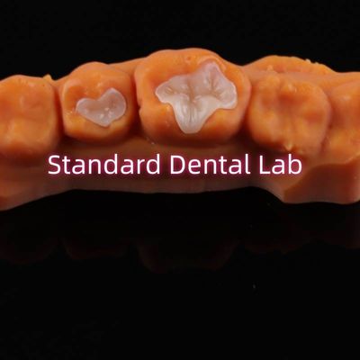 Dental Porcelain Inlay Onlay Overlay Zirconia Emax Komposit Untuk Kerusakan Gigi