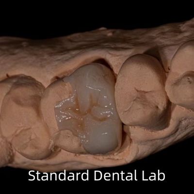 Translucence Emax Zirconia Dental Inlay Onlay Crown Untuk Memulihkan Bentuk Ruang Alam