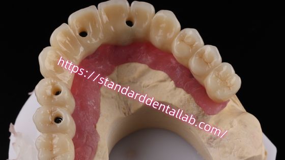 Jembatan Implantasi Berlapis Multi Zirconia Screw Dipertahankan Biokompatibel Pada Struktur Logam