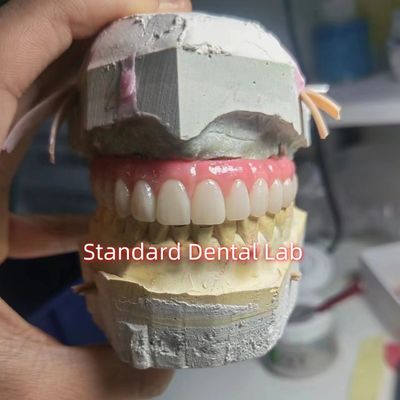Sekrup Titanium PMMA Dental Bridge Temporary Crown