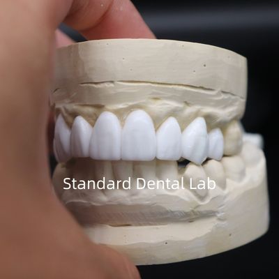 Dental crowns diagnostik wax-up Estetika tinggi dari China Dental Lab