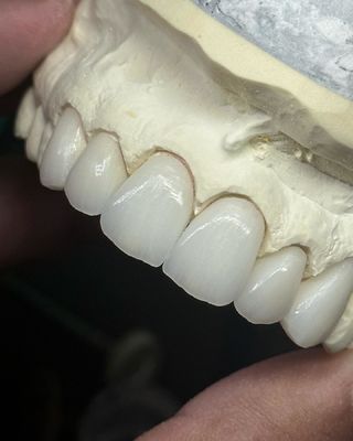 Mahkota Zirconia berlapis Translucence untuk fungsi optimal dan estetika alami