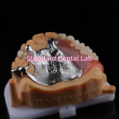 Kerangka Top Cast Acrylic Metal Bagian Gigi Kuat Ringan dan awet