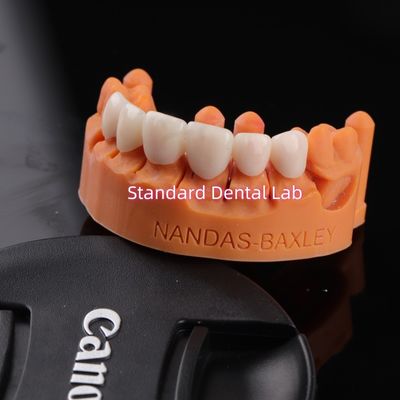 Kenyamanan dan Fungsi dengan Digital CAD CAM Dental Lab Translucent Layered Zirconia Bridge