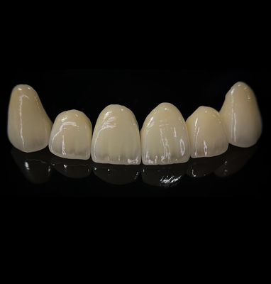 Mahkota Zirconia yang Nyaman dengan Pas dan Estetika yang Tepat