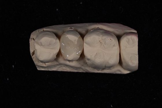 Kekuatan Emax Keramik Veneers Crown dengan ketahanan noda / biokompatibilitas yang sangat baik