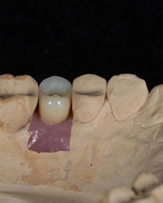 Implan Cement Screw Retained Untuk Implan Gigi Bertahan Lama Dengan Garansi 5 Tahun