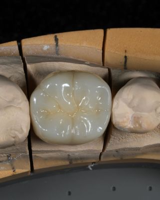 Full Contour Zirconia Crown Quick Turnaround untuk Pas yang Tepat dan Estetis dalam 1 Minggu