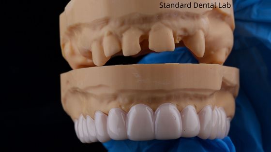 Keindahan Tinggi Gigi Snap On Smile Standar Lab Gigi Alat Gigi Removable