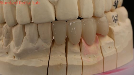 Mahkota Lab Gigi Solid 3D Pro Translucence Tinggi Mahkota Zirconia Penuh dengan Warna Vita Disesuaikan
