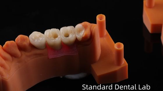 Crown Implantasi Gigi Dengan Sekrup dengan Serat Porselen Berlapis Zirconia PFZ Jaminan 5 Tahun dan Model Cetak 3D
