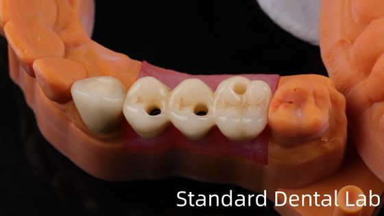 Profesional Zirconia Implan Gigi Mahkota Titanium CAD CAM Zirconia Mahkota China Dental Lab