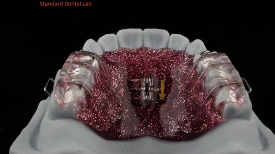 Ekspansi Gigi Dan Distalasi Mengatur Expander Di Mulut Ortodontist Palate Expander