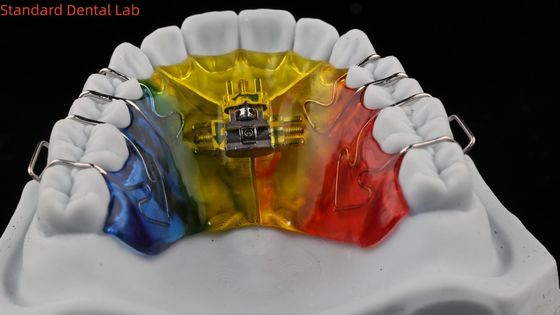 Ekspansi Gigi Dan Distalasi Ahli Ortodontis Palate Expander China Dental Lab