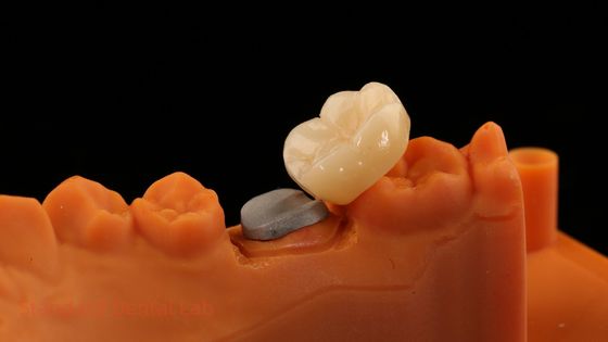 High Esthetic Full Contour Zirconia Crown dengan Metal Post Core 5 Tahun Garansi dan Teknisi Lebih Baik dari SDL Dental Lab