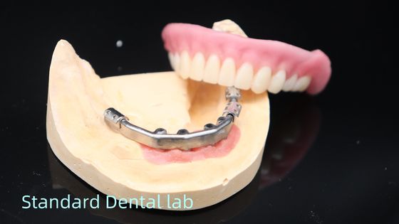 Titanium Implant Denture Mendukung Praktis Ivoclar Denture Over Implants
