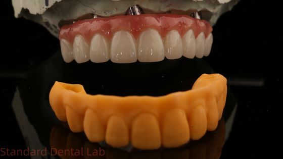 Jaminan 5 Tahun Implantasi Gigi Mahkota PMMA Jembatan Lebih Multi Unit Abutments Disesuaikan Vita Shade