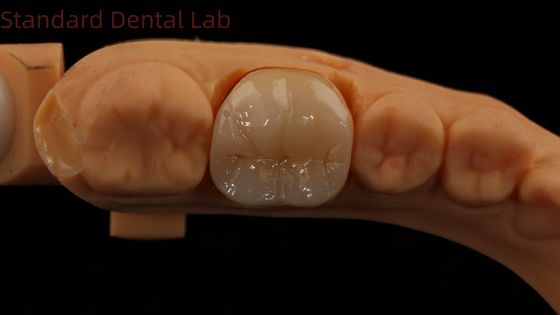 Dental Digital Full Zirconia Crown with Noritake Porcelain 3D Print Model Jaminan 5 Tahun